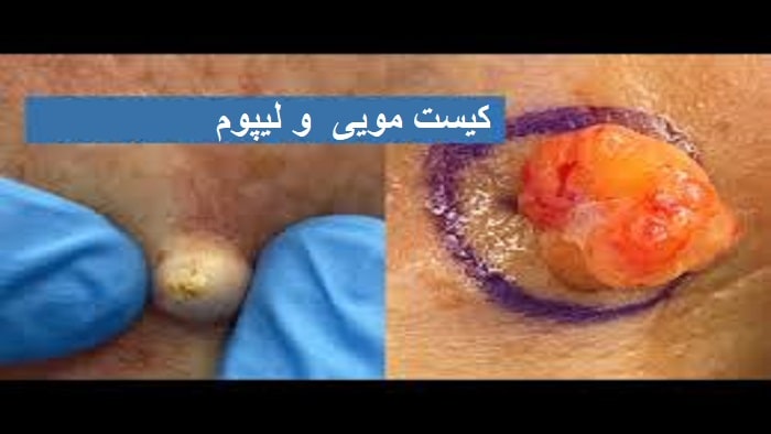 تفاوت کیست مویی و لیپوم