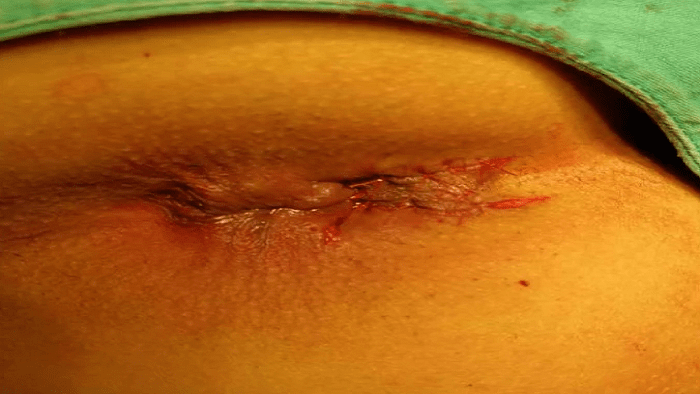 عکس شقاق بعد از عمل