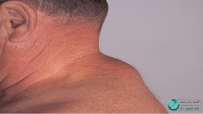 علائم لیپوم