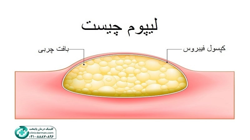 لیپوم چیست