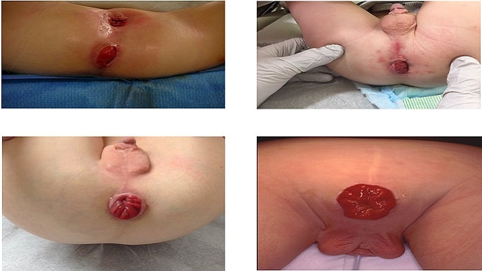 عکس افتادگی روده