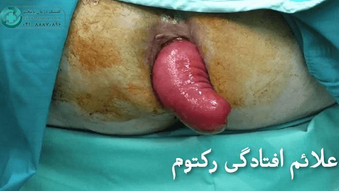 علائم افتادگی روده