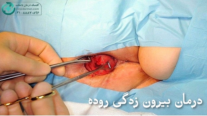 جراحی افتادگی رکتوم