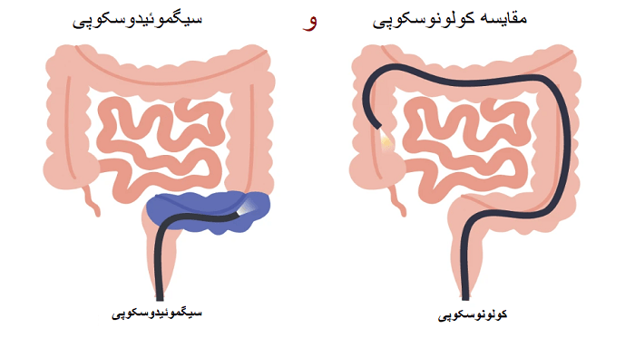 تفاوت سیگموئیدوسکوپی و کولونوسکوپی