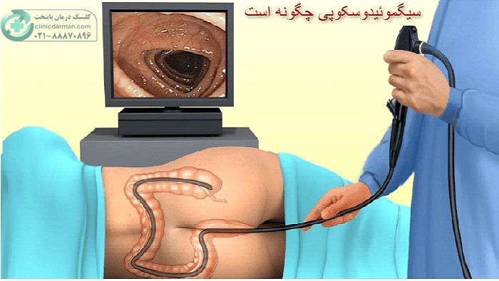 سیگموئیدوسکوپی چگونه است