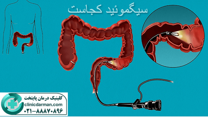 سیگموئید کجاست