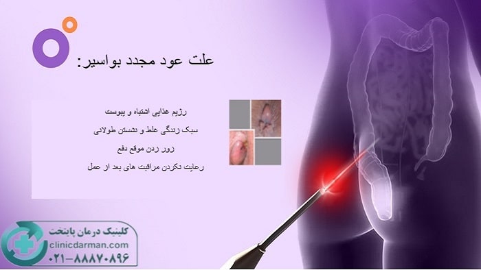 دلایل عود بواسیر