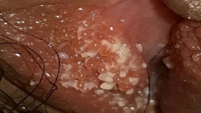 وستیبولار پاپیلوماتوز