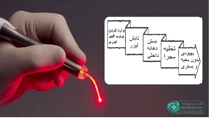 مراحل لیزر فیستول