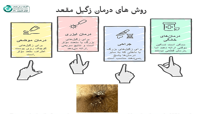 درمان زگیل مقعدی