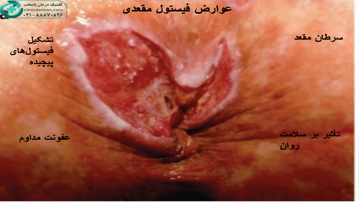 عوارض فیستول