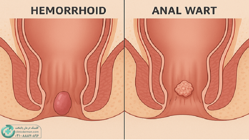 فرق زگیل مقعدی و بواسیر