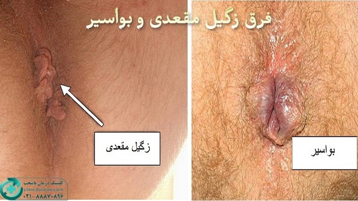 تفاوت زگیل مقعدی و هموروئید