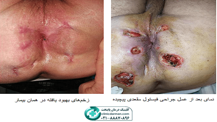 عکس بعد از عمل فیستول
