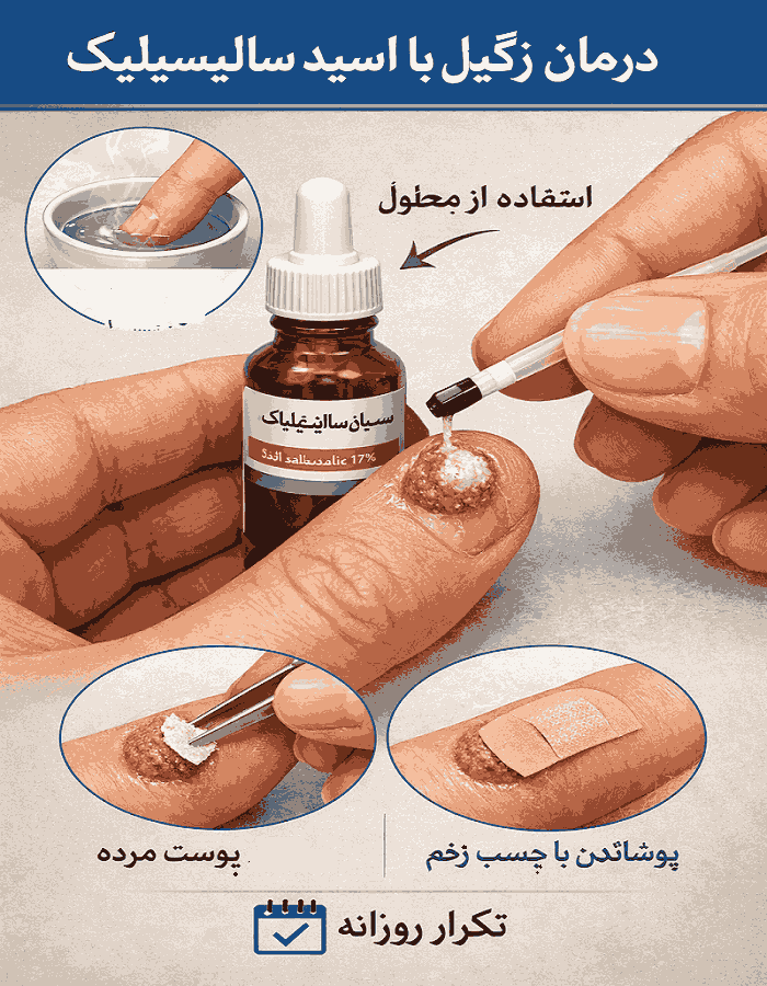 قطره اسید سالیسیلیک برای زگیل تناسلی
