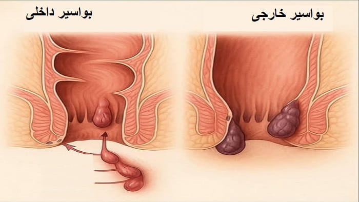 فرق بواسیر داخلی و خارجی
