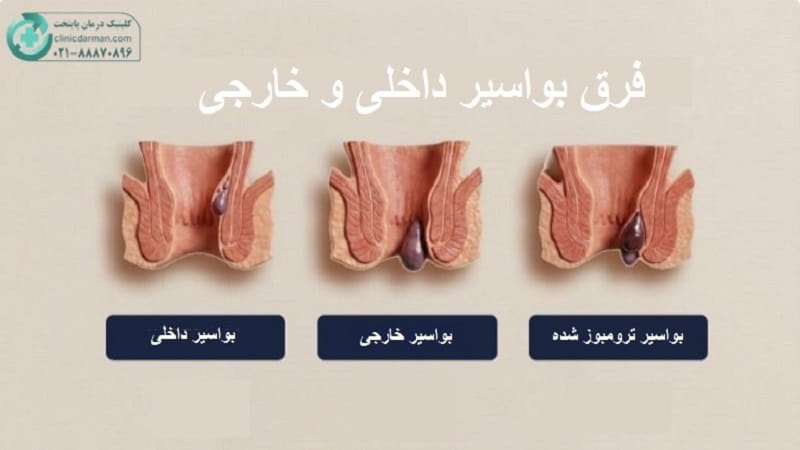 تفاوت بواسیر داخلی و خارجی
